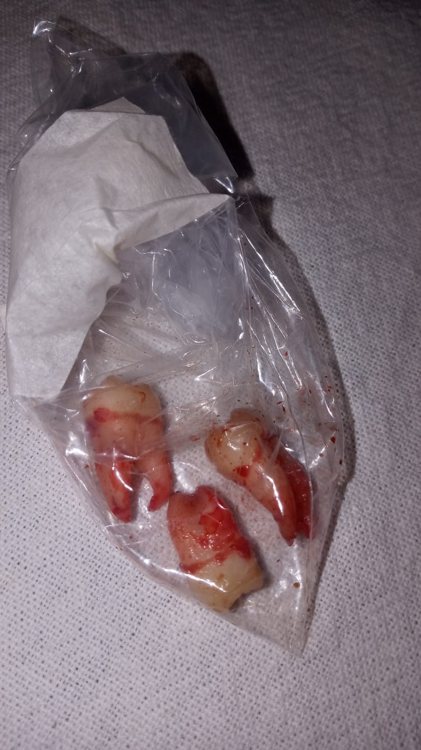 I had my wisdom teeth removed. I was born with only three!